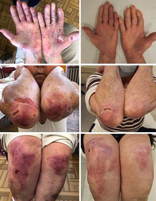 Case Report: Biological treatment of epidermolysis bullosa acquisita: report on four cases and literature review